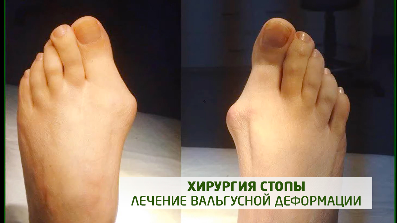 Хирургия стопы. Лечение вальгусной деформации. Hallux valgus