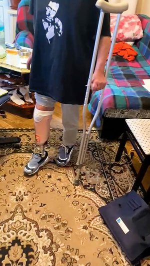 Её протез голени: первая примерочная гильза.