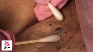 satisfying Removal Blackheads Whiteheads Lyly Beauty ( part 3 )