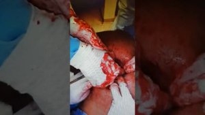 Извлечение  инородного предмета из тела.