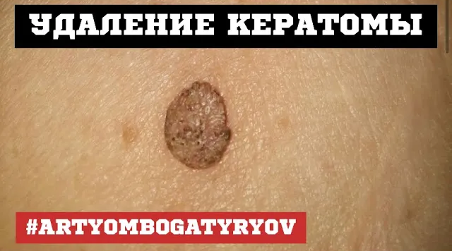 8. КЕРАТОМА - доброкачественно, но лучше УДАЛИТЬ!