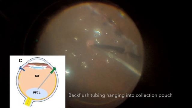 Direct PFCL SO exchange technique modifications смотреть онлайн