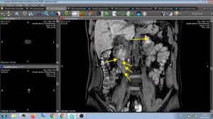МРТ БРЮШНОЙ ПОЛОСТИ .