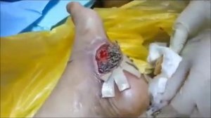 Удаления Личинок с ног человека