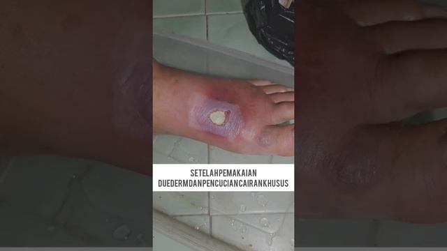 Perawatan Luka pada Diabetes melitus