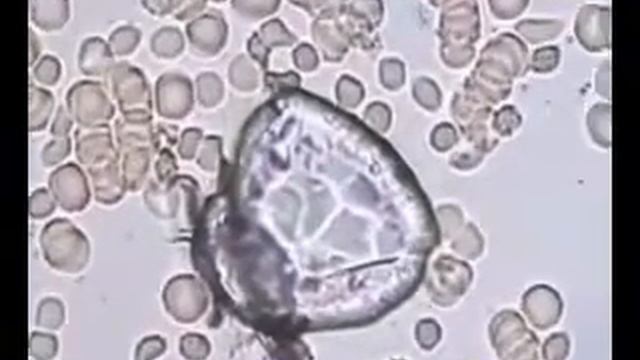 ГЕМОСКАНИРОВАНИЕ ИЛИ ТЕСТИРОВАНИЕ ЖИВОЙ КАПЛИ КРОВИ В ПОЛЕ ФАЗОВО КОНТРАСТНОГО МИКРОСКОПА смотреть онлайн