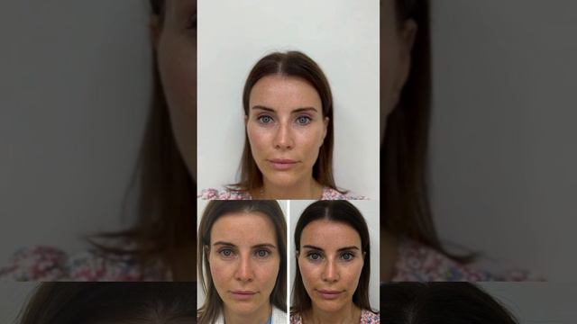 пластика лица, подтяжка лица, лифтинг , ESP lifting.