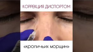 Коррекция «кроличьих морщин»