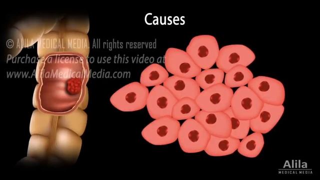 Colon Cancer: Pathology, Symptoms, Screening, Cause and Risk Factors, Animation смотреть онлайн