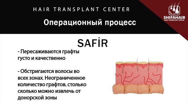 Трансплантация волос в Турции , На видео мы покажем разницу между методом Safir и методом Choi. смотреть онлайн