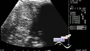 Детское УЗИ брюшной полости - Диссеминированное поражение печени