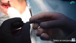 Репозиция костных стенок дна орбиты. Пластика нижнего края орбиты. Профессор Орлов А.А.