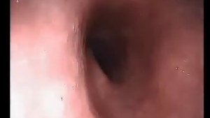 Язва луковицы двенадцатиперстной кишки  Гастроскопия