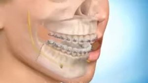 Мезиальный прикус