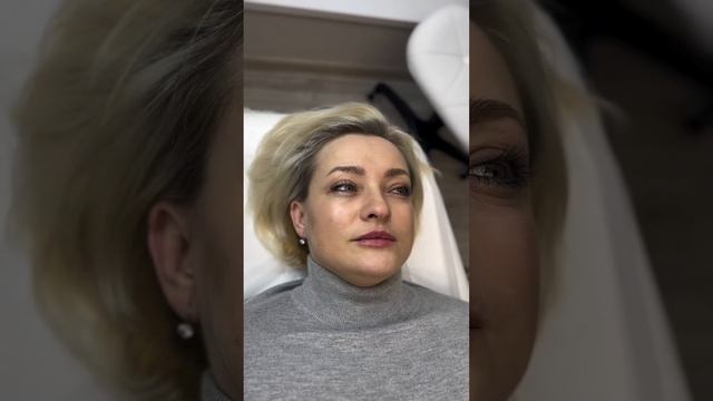 УВЕЛИЧЕНИЕ ГУБ  Препарат Stylage M 1ml  Эффект до 16 мес #врач #врачкосметолог #косметологиямосква #