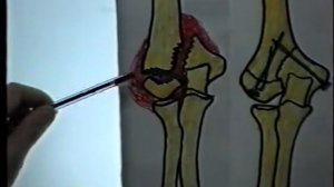 Внутрисуставной  оскольчатый перелом плечевой кости