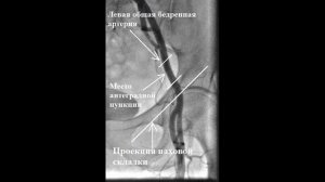 Пункция бедренной артерии (антеградный трансфеморальный доступ)