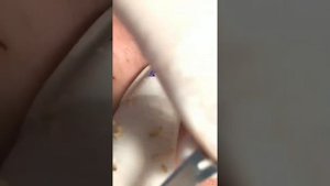 Blackhead removal / Удаление чёрных точек