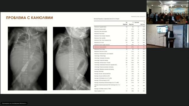 ЭКМО у новорожденных с некардиохирургической патологией смотреть онлайн