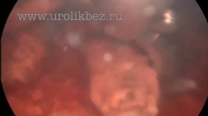 Удаление инородного тела мочевого пузыря forgotten ureteral stent