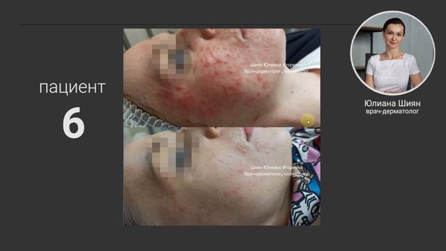 АКНЕ Пациент № 06 До и После смотреть онлайн