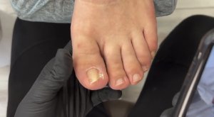 Установка титановой нити