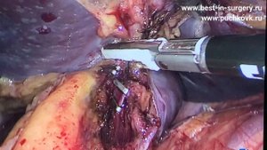 Бескровная лапароскопическая спленэктомия