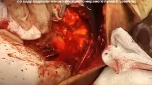 Резекция молочной железы   resection of the breastT2N2M0