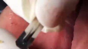 удаление прыщей уха уход за кожей#002