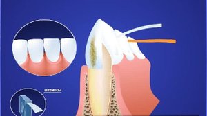 Полировка зубов в 32 Практика