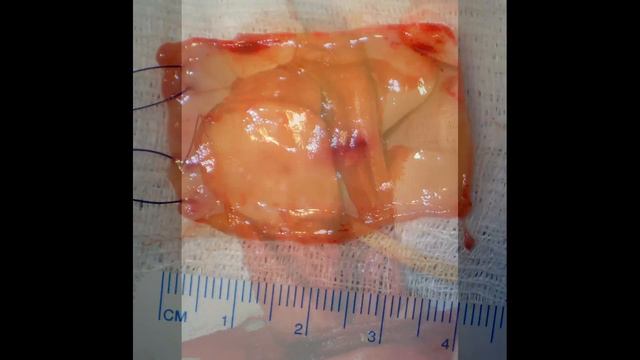 Peyronie_with+Buccal_Mucosa_Graft.wmv смотреть онлайн