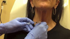 Botox for Platysmal Bands on Neck