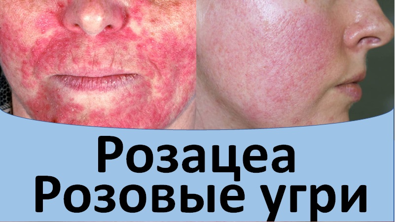 Розацеа. Розовые угри