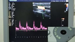 Sonoscape s6 pro - 05 Режим имульсно волновоого допплера 720