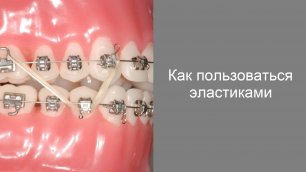 Как пользоваться эластиками с брекетами? Ортодонтия.