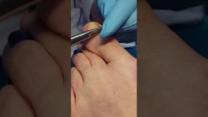 Наталья Кленина. Ставим скобы на вросший ноготь.Курсы