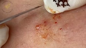 Acne Treament Under The Skin #035