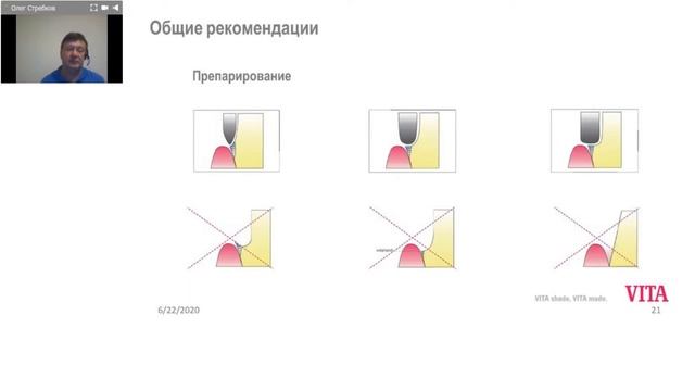Вебінар з Олегом Стребковим "Індивідуалізація металокерамічних реставрацій" смотреть онлайн