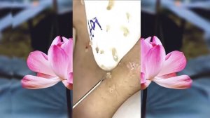 Выдавливание чёрных точек НОВОЕ! Удаление чёрных точек за ухом. p5