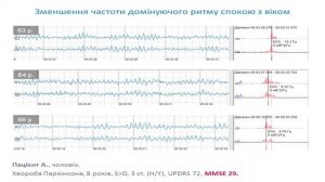 ЕЕГ- маркери змін функціонального стану мозку при хворобі Паркінсона