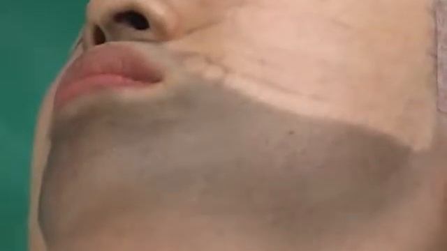 HELIOS Soft peel смотреть онлайн