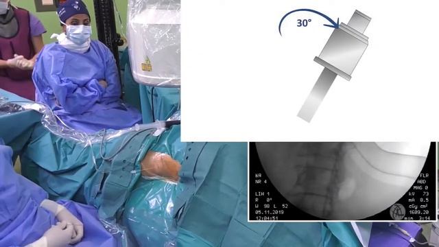 Техника чрескожной нефролитотомии наспине смотреть онлайн