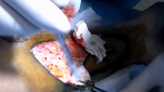 Пластика кожи после ожоговой травмы полноценным свободным лоскутом. смотреть онлайн