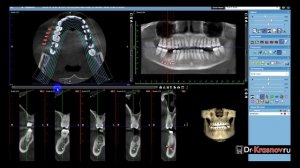 Рисование (трассировка) нижнечелюстного канала в Planmeca Romexis
