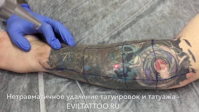 Удаление татуировки на руке неодимовым лазером #удалениетату #удалениетатуаж #лазерноеудалениетату