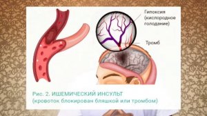 Инсульт:Қалай? Қайдан? Не үшін? | Алғашқы көмек