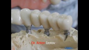 Протезирование  на имплантах