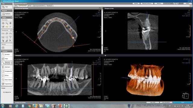 Демонстрация программного обеспечения OnDemand3D Dental смотреть онлайн