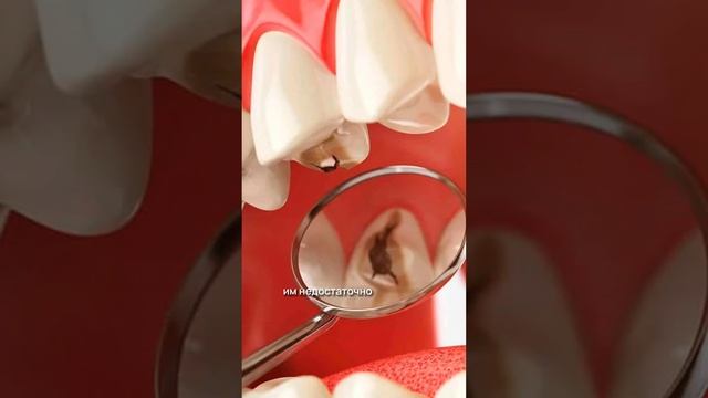 Как образуется кариес? смотреть онлайн