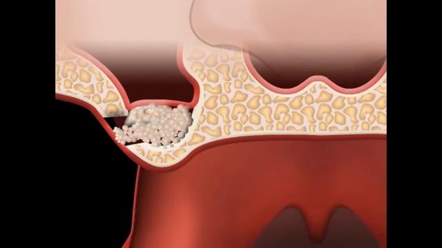 Синус лифтинг в Оренбурге смотреть онлайн